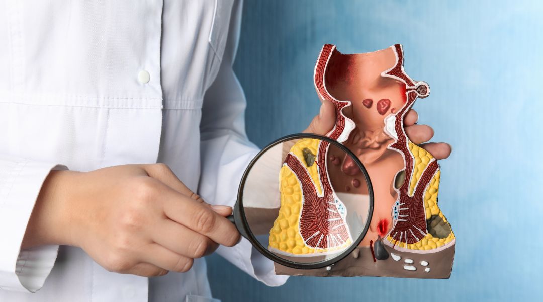 Medical professional holding a magnifying glass over an anatomical model of the anal region