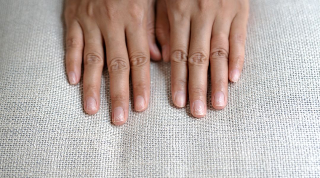 Close-up of two hands with brittle, ridged nails resting on a textured fabric