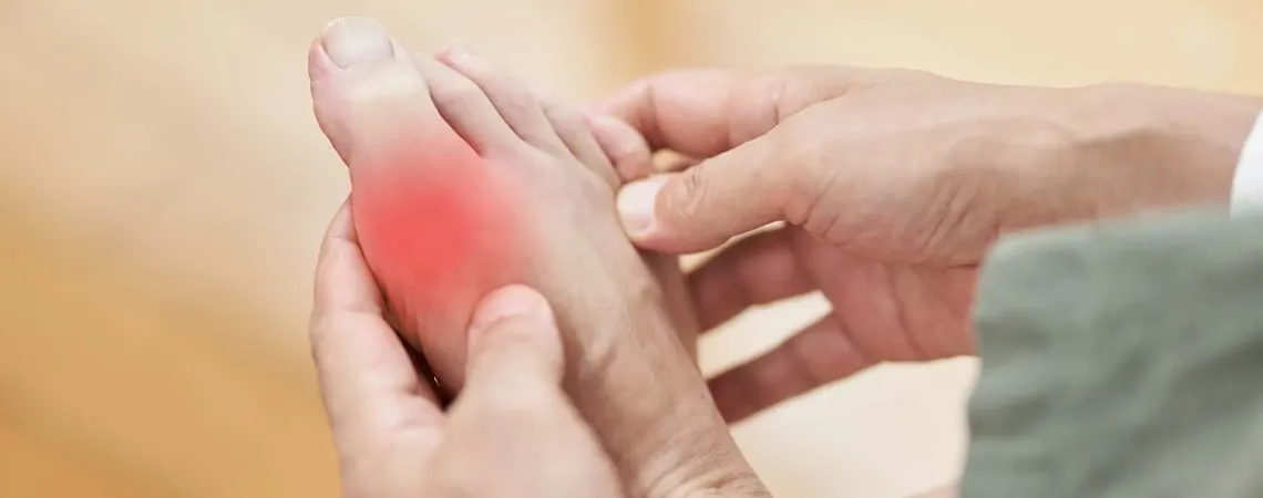 Feet of man suffering from gout - Pied d'homme souffrant de la goutte