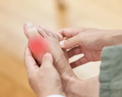Feet of man suffering from gout - Pied d'homme souffrant de la goutte