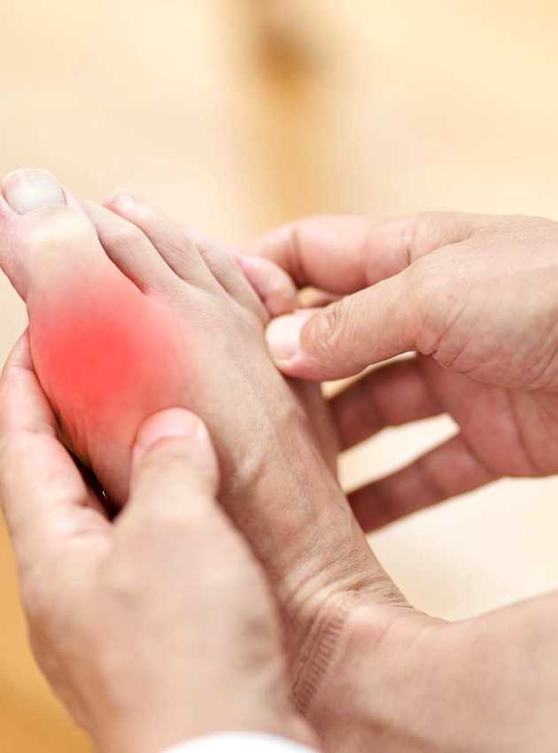 Feet of man suffering from gout - Pied d'homme souffrant de la goutte